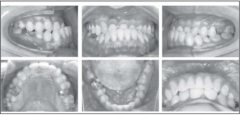 Gambar 3. Asimetri dental pada pasien maloklusi Klas III Angle13 