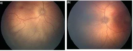 Gambar 1. a) Retina tortuosity, b) Retina non tortuosity [6]