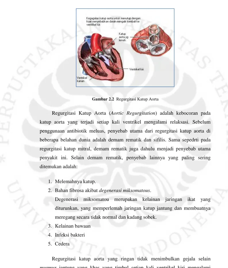 Gambar 2.2  Regurgitasi Katup Aorta 