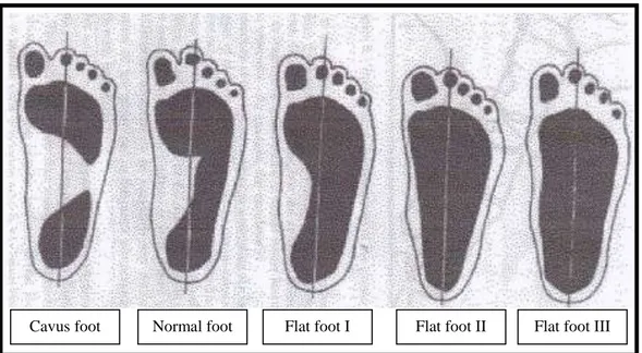 Gambar 4.  Sidik tapak kaki pes cavus (cavus foot), normal, pes planus (flat foot)  Sumber: Olivier dalam Idris, 2010 