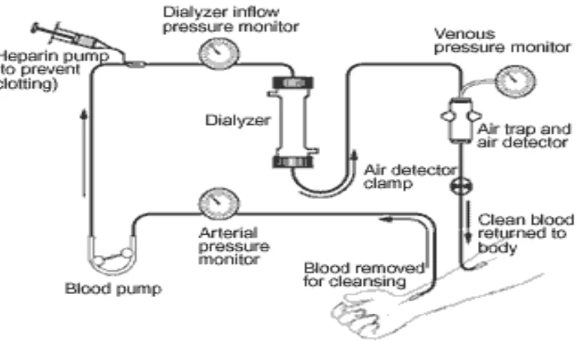 Gambar 1. Proses hemodialisis dalam Treatment Methods for Kidney 
