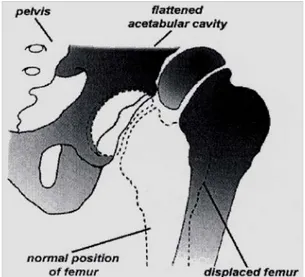 Gambar 1. Diagram  yang memperlihatkan  posisi femur pada panggul normal dan  pada  DPP 3