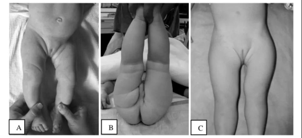 Gambar 4. A, B, Foto seorang bayi dengan asimetri lipatan kulit paha/inguinal dan lipatan poplitea  yang dalam pada sisi panggul kiri yang terdislokasi