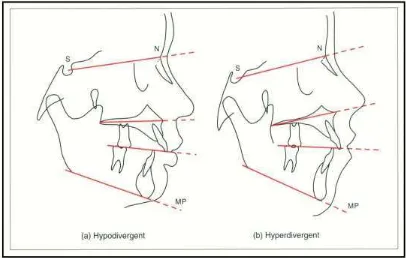 Gambar 12. (a) Hypodivergent, sudut MP-SN lebih kecil.         (b) Hyperdivergent, sudut MP-SN lebih besar.10 