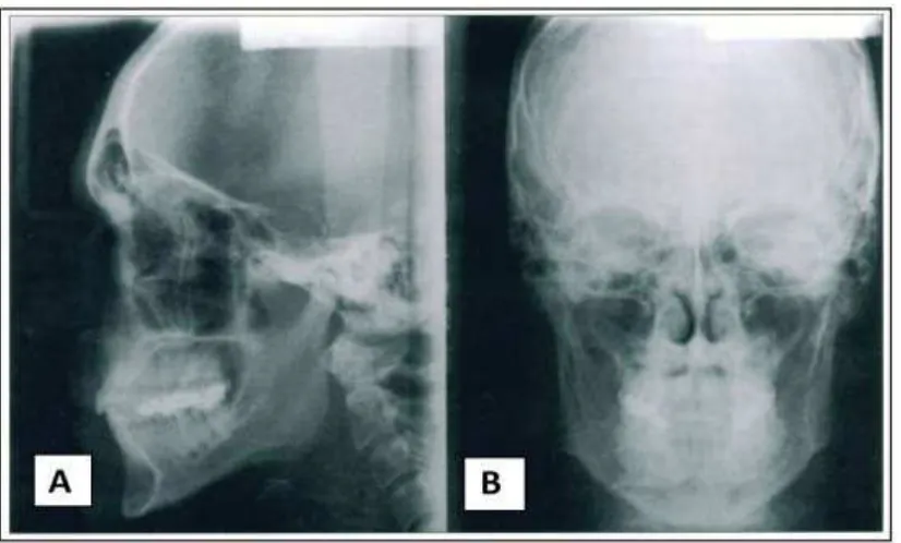Gambar 1.(A) Sefalometri lateral, (B) Sefalometri frontal 10 