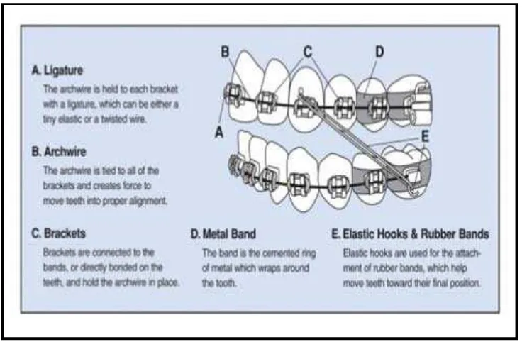 Gambar 4.  A. Ligature  B. Archwire C. Bracket  D. Metal Band  E. Elastic      Hooks dan Rubber Bands35 