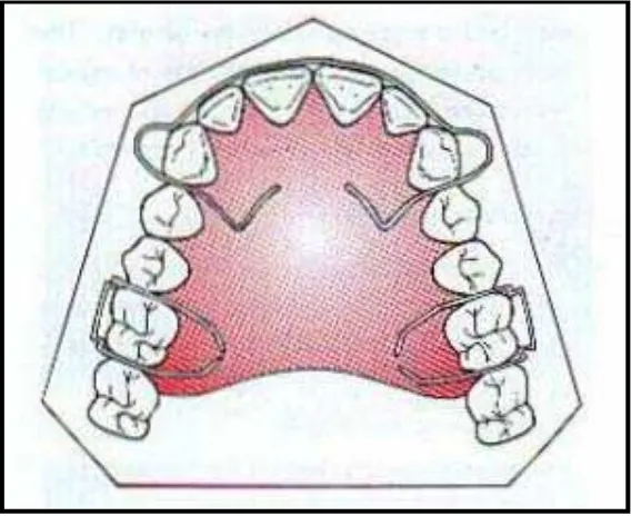 Gambar 3. Piranti ortodonti lepasan28 