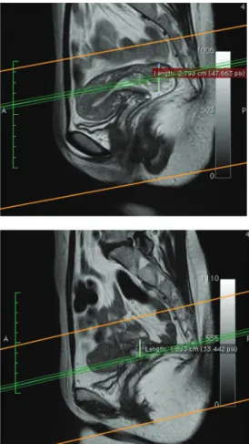 Gambar 3: Hasil pemeriksaan MRI subjek nomor 2. Ny. EK. Sebelum  (A,C) dan sesudah (B,D) kemoterapi adjuvan cisplatin.