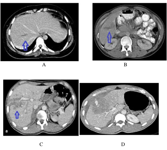 Gambar 1. Pembagian derajat trauma hepar berdasarkan CT Scan abdomen        dengan kontras ( Becker, et al., 1998 ) 