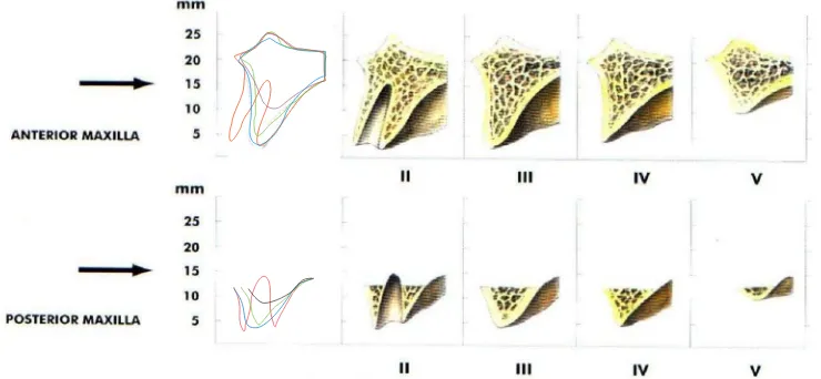 Gambar 3 : Klasifikasi resobsi tulang maksila (Caswood, 1999) 
