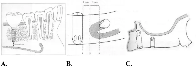 Gambar 1 Jarak aman terhadap struktur penting diskitar implan (McGlumpy, 2003):  A. Implan terhadap bagian superior dari syaraf  alveolar inferior;   B