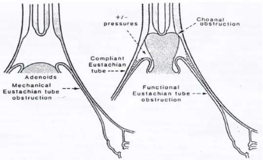 Gambar 4. Mekanisme adenoid obstruktif.  3