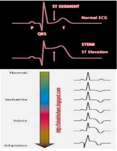 Gambar 1.  ECG Normal dan abnormal (http://uchicagomed.files.wordpress.com) 