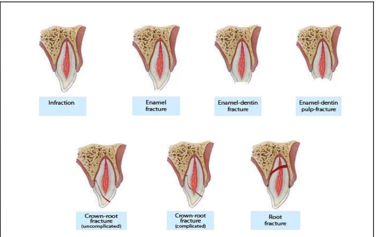 Gambar 1. Kerusakan pada jaringan keras gigi dan pulpa 16