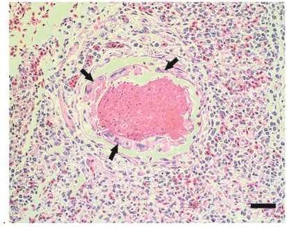 Gambar  10   Paru  U  50/13  umur  14  hari.  Radang  granuloma  invasif  yang  tidak  penuh  dikelilingi  oleh jaringan ikat (panah)