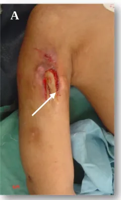 Gambar 1A Foto penderita osteomielitis kronis pada lengan atas kanan dengan sekuester yangcukup besar (lihat panah)