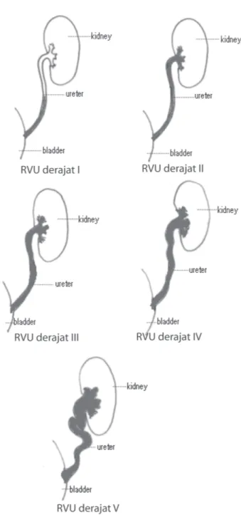 Gambar 5. Derajat RVU (menurut International Reflux Study Grading System) 8