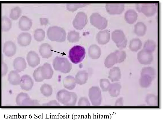 Gambar 5 Sel Makrofag dan Neutrofil (panah hitam)23 
