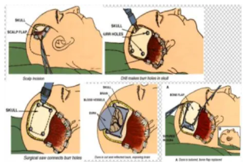Gambar 2.4 : Gambar lapisan kulit kepala yang dilakukan  Tindakan Craniotomy 