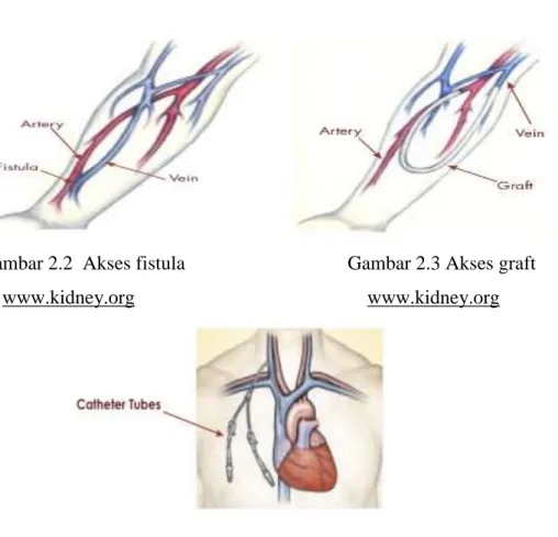 Gambar 2.2  Akses fistula  Gambar 2.3 Akses graft 