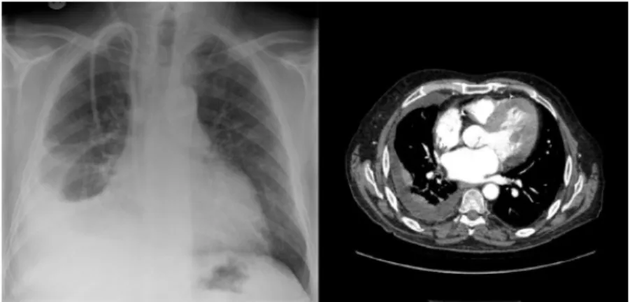 Gambar 2.3.  Foto thoraks dan computed tomography scan yang  menunjukkan adanya efusi pleura pada sisi kanan