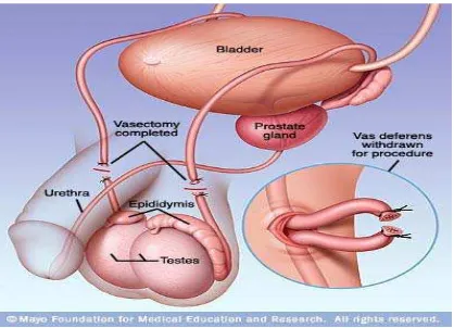 Gambar 2.1. Metode Vasektomi 