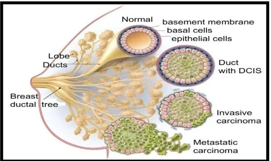 Gambar 5. Kanker Payudara Duktal Invasif. (Sumber: Science Breast Cancer).19 