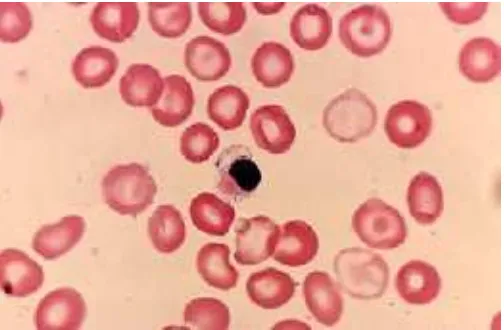 Gambar 2.1. Morfologi eritrosit penderita Thalassemia(Lichtman’s Atlas of Hematology)