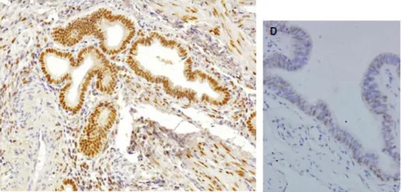 Gambar 5. Ekspresi PR pada jaringan endometriosis 51