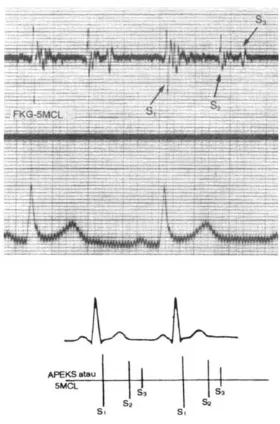 Gambar 1. Munculnya suara jantung S1, S2, dan S3 pada jantung normal [9] 
