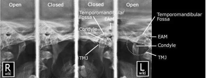 Gambar 9. TMJ bilateral pada posisi menutup dan membuka mulut 