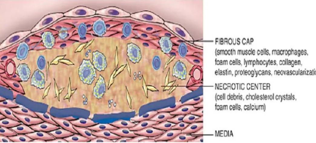 Gambar 5. Morfologi Plak Aterosklerosis  38