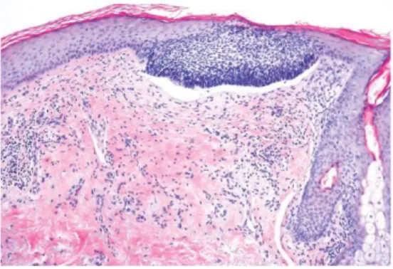 Gambar  2.5.  Karsinoma  sel  basal  jenis  superfisial.  Kelompok  sel  basaloid  atipikal  padat  muncul  pada  penghubung  dermo-epidermis,  menunjukkan  bentuk  pagar/palisade  di  bagian  perifer  dan  bentuk  celah  antara  sarang  tumor  dan  lapisa