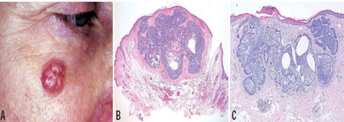 Gambar  2.6.  Karsinoma  sel  basal  jenis  nodular.  A  dan  B.  Lapisan  epidermis  meningkat  dengan  flatt rete ridges dgn kelompok sel basaloid atipikal padat dan kistik, palisading perifer menunjukkan  invasi  lapisan  dermis  dalam  pada  pola    no