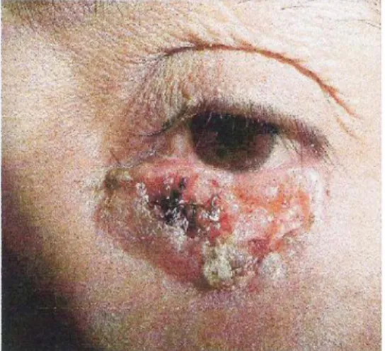 Gambar  2.7.  Karsinoma  sel  basal  noduloulseratif  berpigmen  pada  kelopak  mata  kanan  bagian  bawah