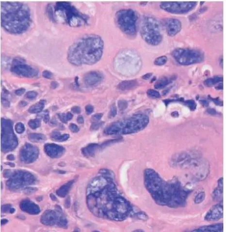 Gambar 2.10. Karsinoma sel basal nodular dengan sel raksasa. 6 