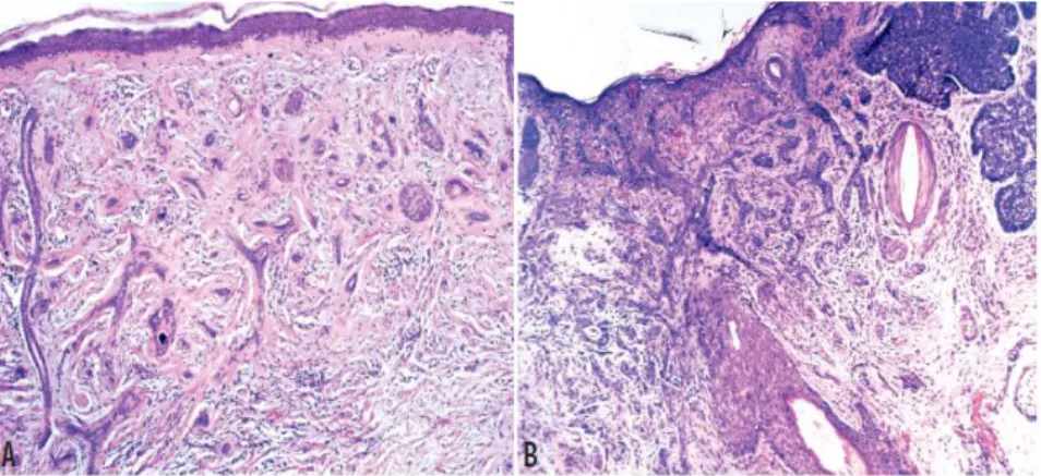 Gambar  2.11.  A.  Karsinoma  sel  basal  infiltratif.  B.  Karsinoma  sel  basal  campuran  infiltratif  dan  nodular