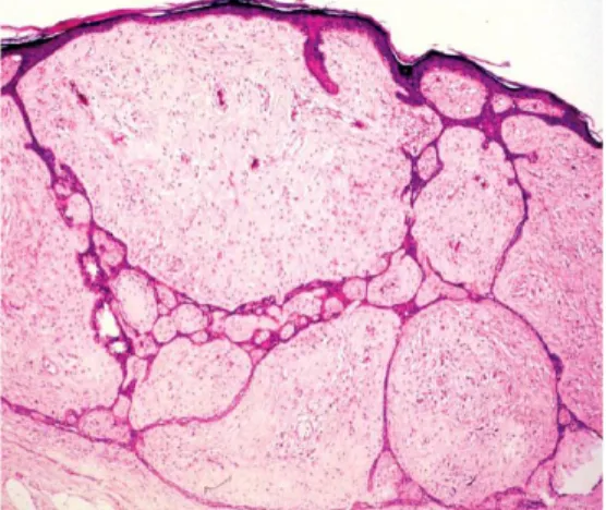 Gambar 2.12. Karsinoma sel basal fibroepitel (fibroepitelioma Pinkus). 6