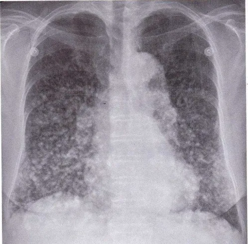 Gambar 2.14 metastasis melanoma. A: PA radiografi memperlihatkan multiple 