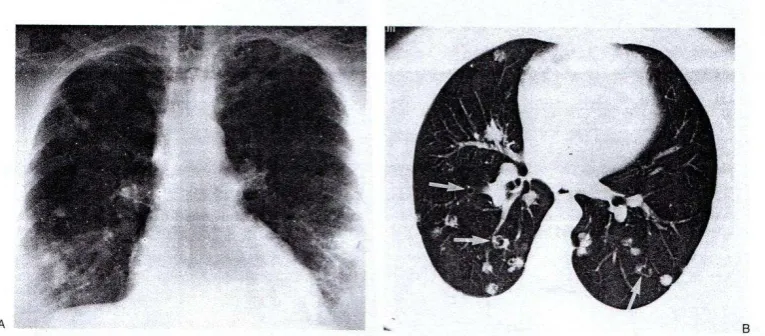 Gambar 2.16 metastasis kanker serviks. A: PA radiografi memperlihatkan 