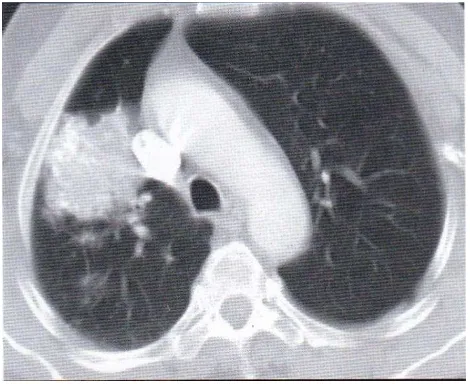 Gambar 2.3  metastasis chondrosarcoma. Metastasis tipikal mempunyai ukuran 