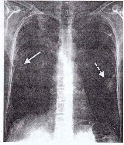 Gambar 2.6 metastasis kanker usus. PA : radiografi memperlihatkan small 