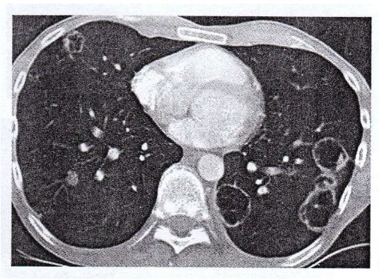 Gambar 2.9  metastasis adenocarcinoma colon: miliary pattern. Radiografi 