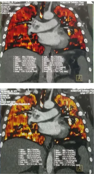 Gambar 2. Hasil Analisis Lung PBV Arteri  Pulmonalis Kanan Superior (a) perhitungan axial  pertama (b) perhitungan axial kedua (c) perhitungan 