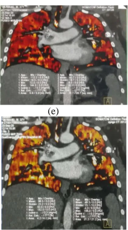 Gambar 3. Hasil Analisis Lung PBV Arteri  Pulmonalis Kanan Inferior (a) perhitungan axial 