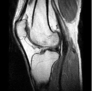 Figure 1. MRI Scan Image on Knee 