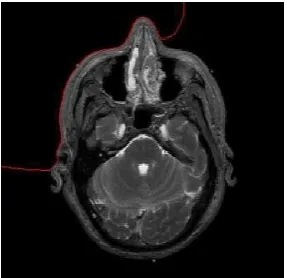 Figure 2. Image Segmentation Result using DRLSE 