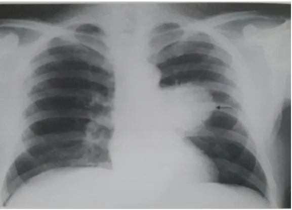 Gambar 2.6. Hamartoma 