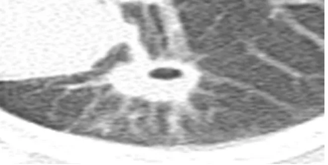 Gambar 2.3.  Tumor jinak 