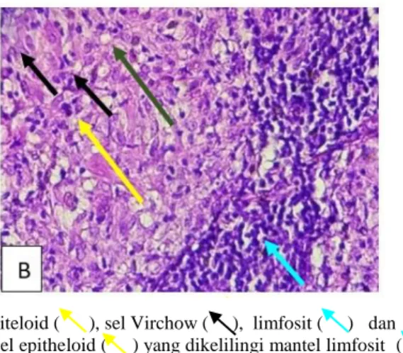Gambar 3A. Tampak granuloma  yang  difus  terdiri atas sejumlah sel epiteloid (      ), sel Virchow (     ),  limfosit (     )   dan   neutrophil   (     ) (H&amp;E, 200x)
